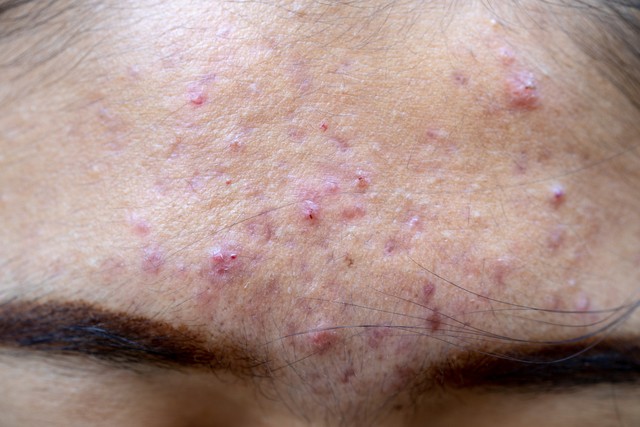 關於臉上的痘痘，我有一些治療方法想告訴大家，建議收藏